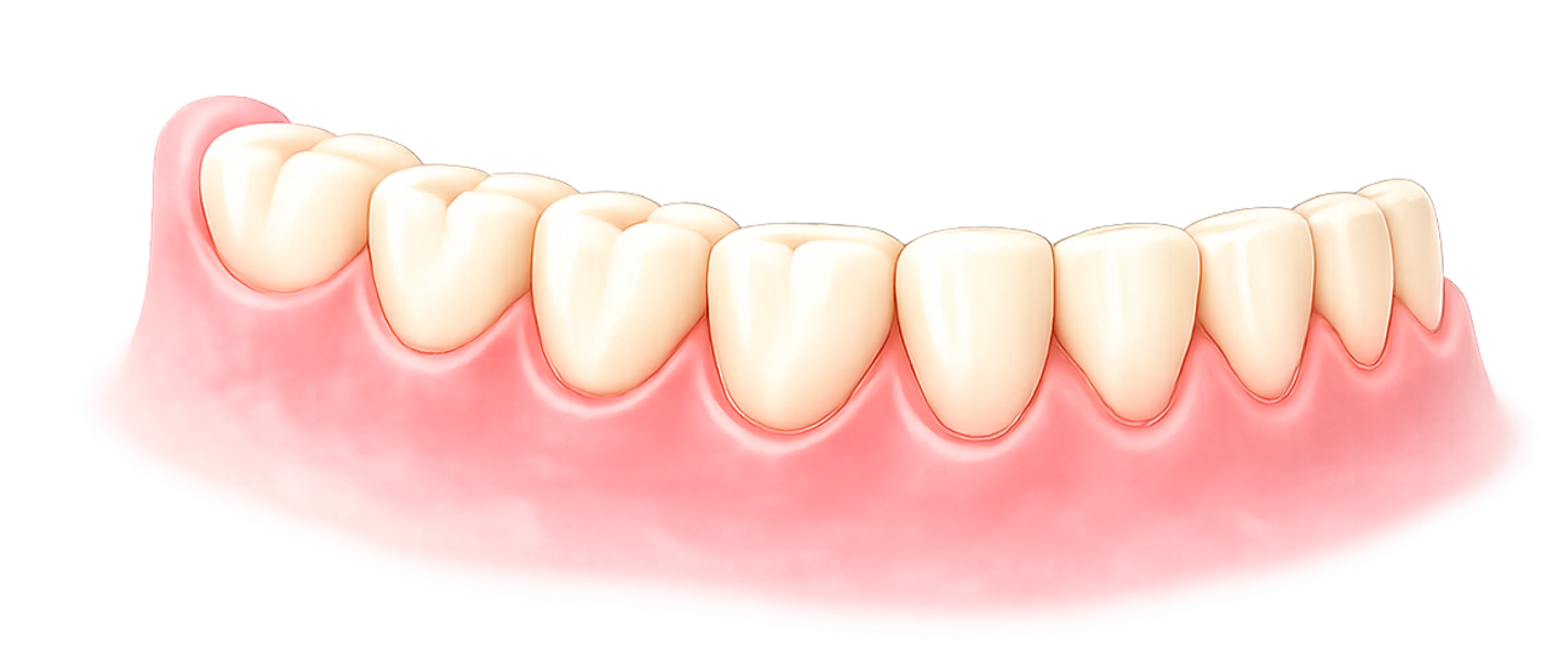 コーヌステレスコープ義歯イメージ